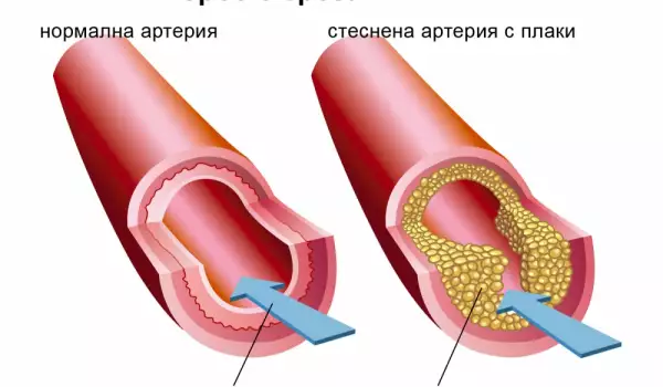 Atherosclerosis